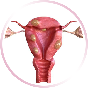 Miomatosis Uterina