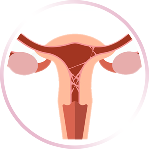 Adherencias Endometriales