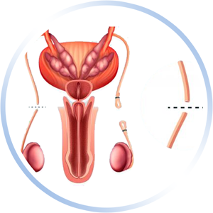 Vasectomía