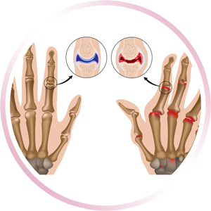 Artritis Reumatoide